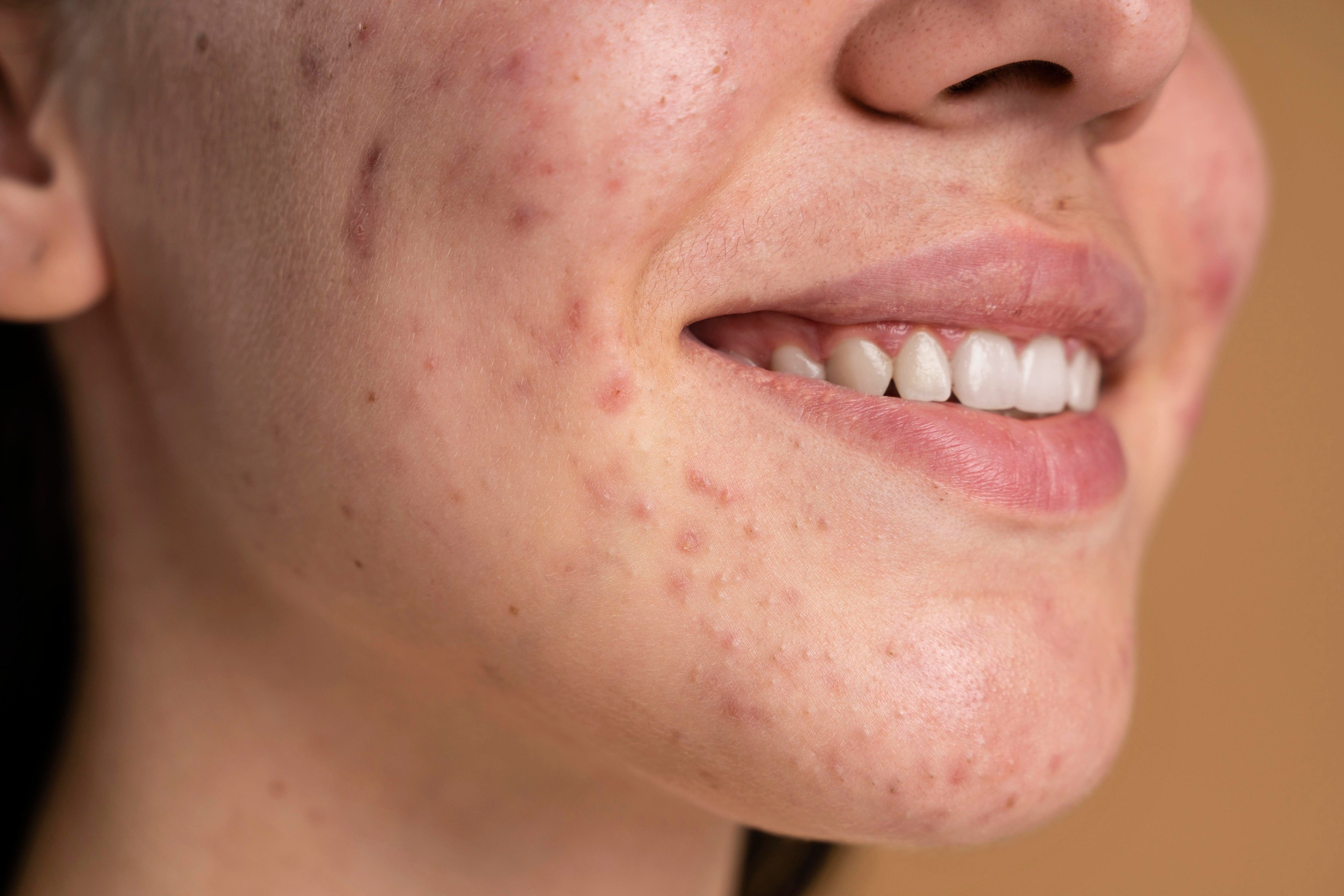 Spot Treatments